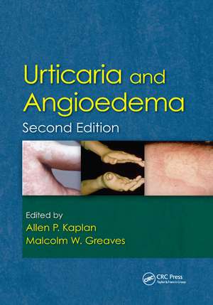 Urticaria and Angioedema de Allen Kaplan