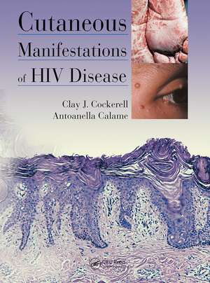 Cutaneous Manifestations of HIV Disease de Clay Cockerell