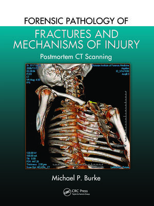 Forensic Pathology of Fractures and Mechanisms of Injury: Postmortem CT Scanning de Michael P. Burke