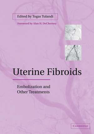 Uterine Fibroids: Embolization and other Treatments de Togas Tulandi