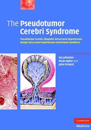 The Pseudotumor Cerebri Syndrome: Pseudotumor Cerebri, Idiopathic Intracranial Hypertension, Benign Intracranial Hypertension and Related Conditions de Ian Johnston