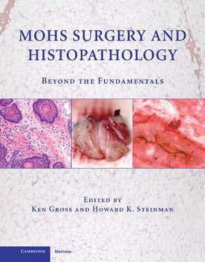 Mohs Surgery and Histopathology: Beyond the Fundamentals de Ken Gross MD