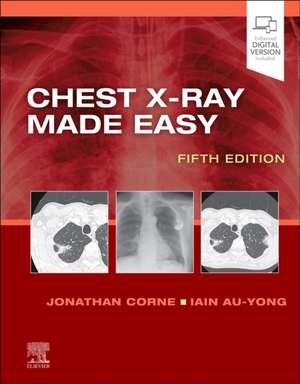 Chest X-Ray Made Easy de Jonathan Corne