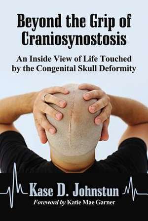 Beyond the Grip of Craniosynostosis: An Inside View of Life Touched by the Congenital Skull Deformity de Kase D. Johnstun