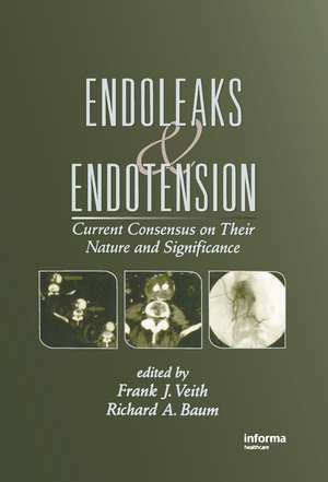 Endoleaks and Endotension: Current Consensus on Their Nature and Significance de Frank J. Veith