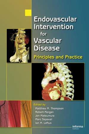 Endovascular Intervention for Vascular Disease: Principles and Practice de Matt M. Thompson