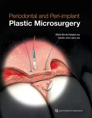 Periodontal and Peri-implant Plastic Microsurgery: Minimally Invasive Techniques with Maximum Precision de Glécio Vaz de Campos