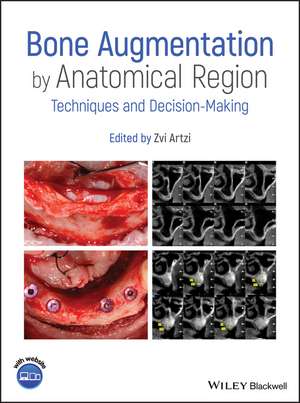 Bone Augmentation by Anatomical Region – Techniques and Decision–Making de Z Artzi