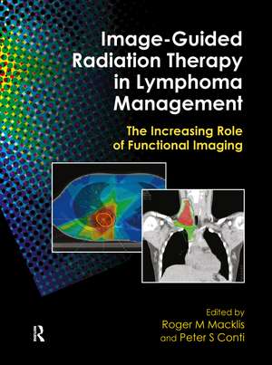 Image-Guided Radiation Therapy in Lymphoma Management: The Increasing Role of Functional Imaging de Roger M. Macklis