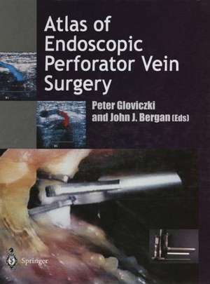 Atlas of Endoscopic Perforator Vein Surgery de Peter Gloviczki