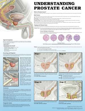 Understanding Prostate Cancer 2e Laminated de Anatomical Chart Company