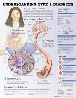 Understanding Type 1 Diabetes Anatomical Chart de Anatomical Chart Company