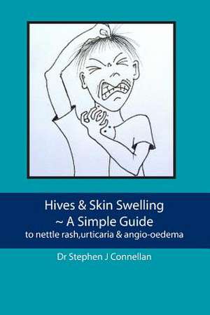 Hives & Skin Swelling a Simple Guide de Stephen J. Connellan