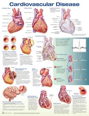 Cardiovascular Disease Anatomical Chart de Anatomical Chart Company