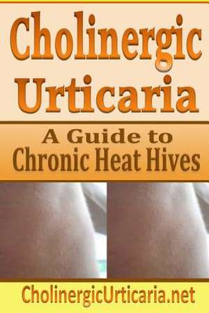 Cholinergic Urticaria de B. Page