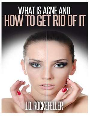 What Is Acne and How to Get Rid of It de Rockefeller, J. D.