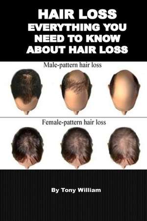 Hair Loss de William, Toney