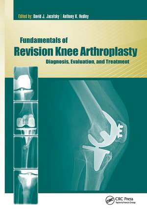 Fundamentals of Revision Knee Arthroplasty: Diagnosis, Evaluation, and Treatment de David Jacofsky