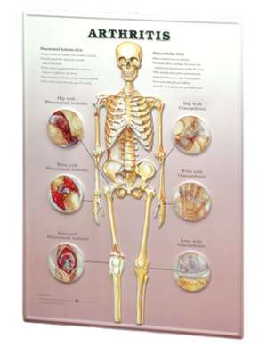 Arthritis: 3D Lenticular Chart de Anatomical Chart Company