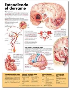 Understanding Stroke Anatomical Chart in Spanish (Entendiendo qué es un derrame) de Anatomical Chart Company