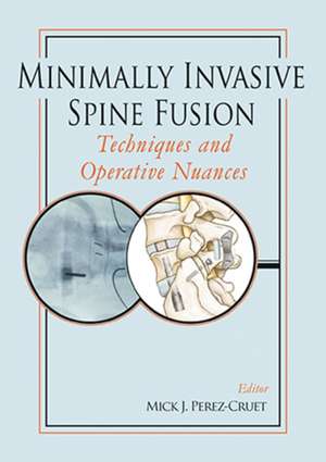 Minimally Invasive Spine Fusion de Mick Perez-Cruet