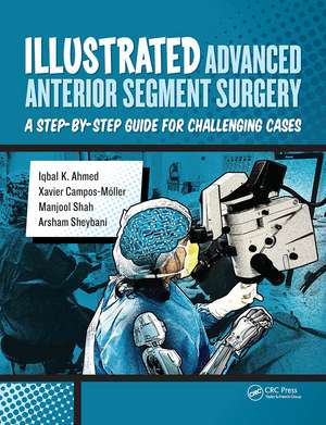 Illustrated Advanced Anterior Segment Surgery: A Step-by-Step Guide for Challenging Cases de Iqbal Ahmed