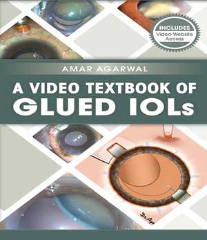 A Video Textbook of Glued IOLs de Amar Agarwal