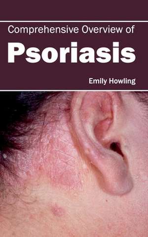 Comprehensive Overview of Psoriasis de Emily Howling