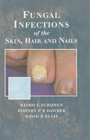 Fungal Infections of the Skin and Nails de Raimo E. Suhonen