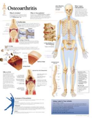 Understanding Osteoarthritis Chart: Wall Chart de Scientific Publishing