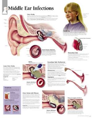 Middle Ear Infection Chart: Laminated Wall Chart de Scientific Publishing