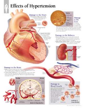 Effects of Hypertension Chart: Wall Chart de Scientific Publishing