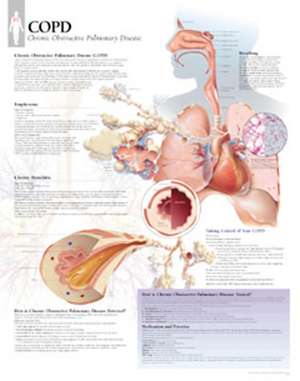 Copd Chart: Wall Chart: Wall Chart de Scientific Publishing