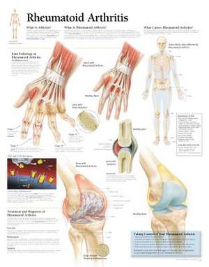 Rheumatoid Arthritis: Laminated Wall Chart de Various