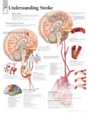 Understanding Stroke Chart: Laminated Wall Chart de Scientific Publishing