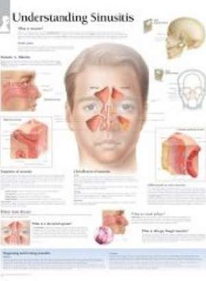 Understanding Sinusitis Laminated Poster de Scientific Publishing