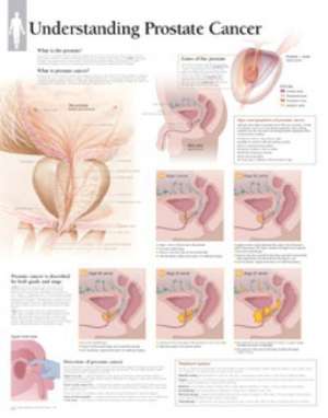 Understanding Prostate Cancer de Scientific Publishing