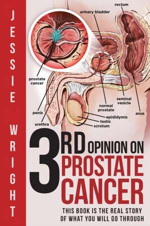 3rd Opinion on Prostate Cancer de Jessie Wright