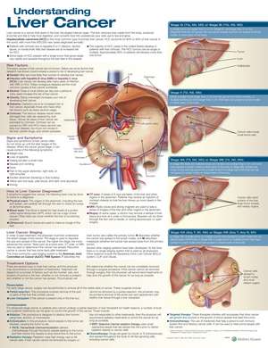 Understanding Liver Cancer Anatomical Chart de Anatomical Chart Company