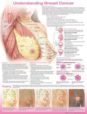 Understanding Breast Cancer Anatomical Chart de Anatomical Chart Company