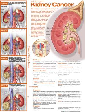 Understanding Kidney Cancer Anatomical Chart de Anatomical Chart Company