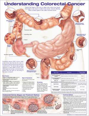 Understanding Colorectal Cancer Anatomical Chart de Anatomical Chart Company