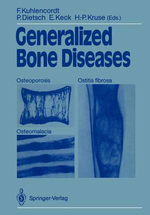 Generalized Bone Diseases: Osteoporosis Osteomalacia Ostitis fibrosa de Friedrich Kuhlencordt