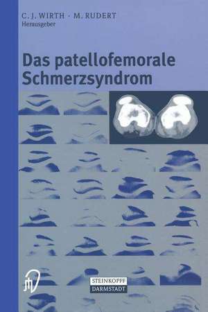 Das patellofemorale Schmerzsyndrom de C. J. Wirth