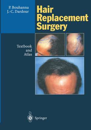 Hair Replacement Surgery: Textbook and Atlas de Pierre Bouhanna