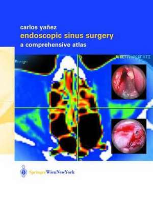 Endoscopic Sinus Surgery: A Comprehensive Atlas de Carlos Yañez