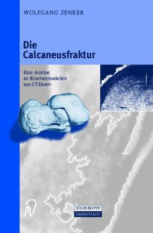 Die Calcaneusfraktur: Eine Analyse an Knochenmodellen aus CT-Daten de Wolfgang Zenker