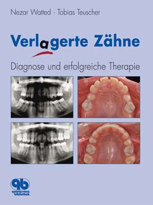 Verlagerte Zähne: Diagnose und erfolgreiche Therapie de Nezar Watted