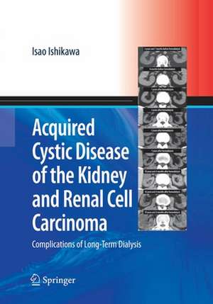 Acquired Cystic Disease of the Kidney and Renal Cell Carcinoma: Complication of Long-Term Dialysis de Isao Ishikawa