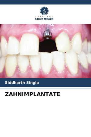 ZAHNIMPLANTATE de Siddharth Singla